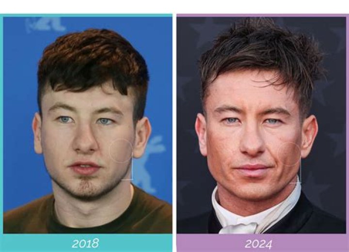 Barry Keoghan's Surgery Secrets Unveiled: The Untold Story