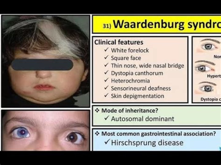 Waardenburg Syndrome: Unveiling the Rare Genetic Condition with Henning Wehn Insights